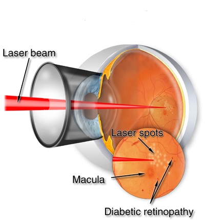 Applications of the laser in ophthalmology