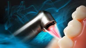 معرفی کاربردهای لیزر در دندانپزشکی