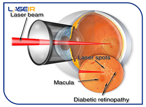 کاربرد لیزر در چشم پزشکی