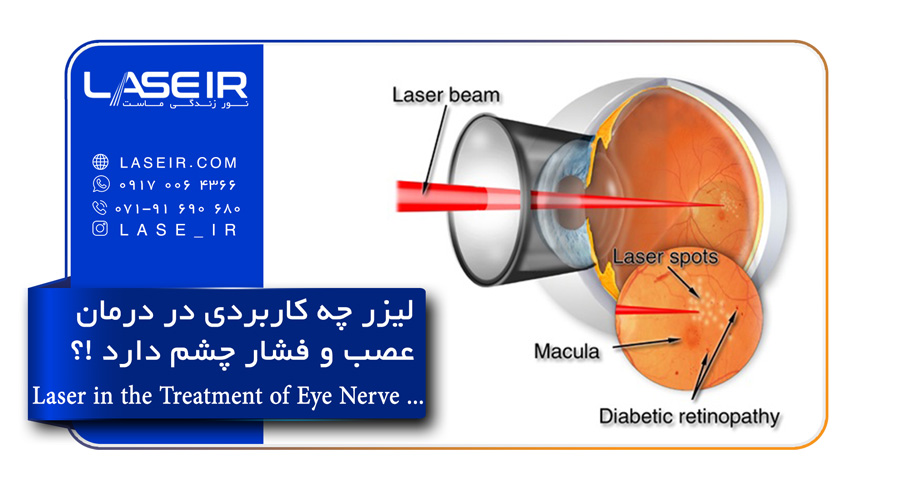 لیزر در درمان بیماری های عصب و فشار چشم